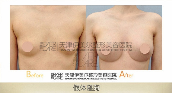 天津伊美爾隆胸